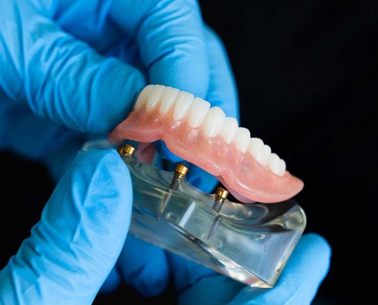 Prothese-sur-implant-quebec