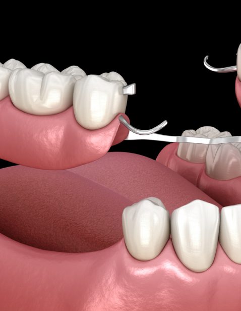 Prothèses partielles - Denturologiste Maria Ramirez